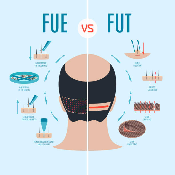 ilustrações, clipart, desenhos animados e ícones de fue vs fut - alopecia homem