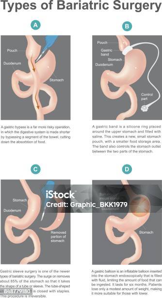 Arten Der Adipositaschirurgie Stock Vektor Art und mehr Bilder von Operation - Operation, Bariatrie, Magen