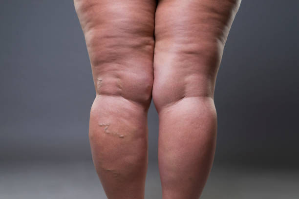 closeup de las varices, piernas grasa celulitis femenina - pierna humana fotografías e imágenes de stock