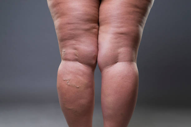 Varicose veins closeup, fat female cellulite legs Varicose veins closeup, fat female cellulite legs on gray background human leg stock pictures, royalty-free photos & images