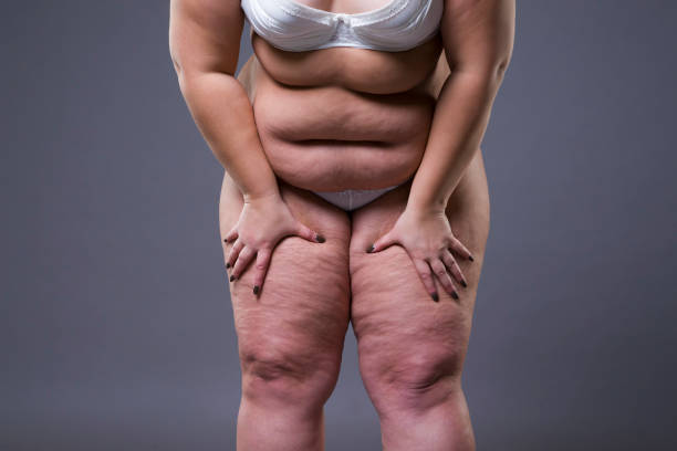 übergewichtige frau mit dicken beinen und magen, übergewicht weiblicher körper - overweight tummy tuck abdomen body stock-fotos und bilder