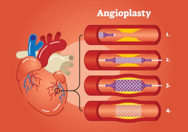 angioplastie-abbildung - angioplasty stock-grafiken, -clipart, -cartoons und -symbole