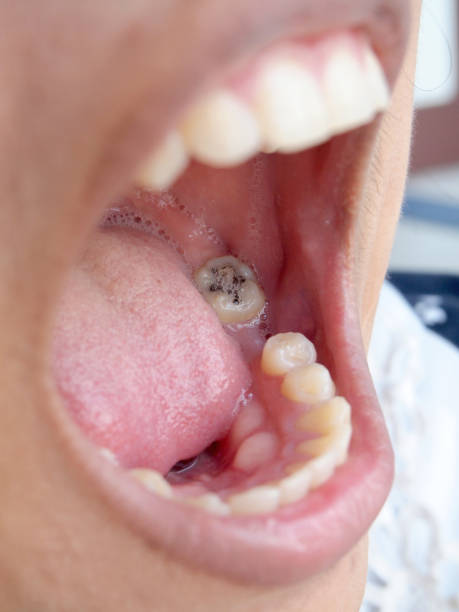 istock Human teeth with cavity needing treatment photographed from a rare angle 849317512