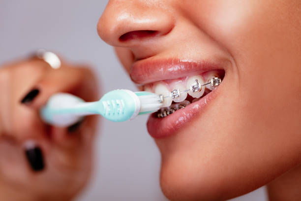 Brushing Teeth With Braces Close-up of a smiling woman face with braces on white teeth and toothbrush. braces stock pictures, royalty-free photos & images