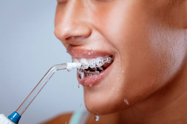 Water Flosser Close-up of a smiling woman face with braces cleaning her teeth with oral irrigator. dental floss stock pictures, royalty-free photos & images