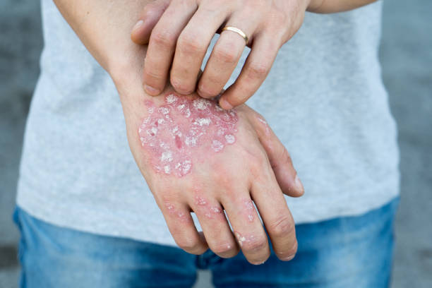 Man scratch oneself, dry flaky skin on hand with psoriasis vulgaris, eczema and other skin conditions like fungus, plaque, rash and patches. Autoimmune genetic disease. Man scratch oneself, dry flaky skin on hand with psoriasis vulgaris, eczema and other skin conditions like fungus, plaque, rash and patches. Autoimmune genetic disease. epidermal cell stock pictures, royalty-free photos & images