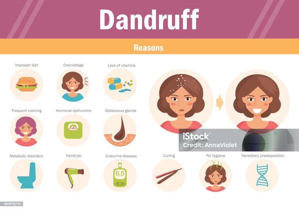 Reasons of dandruff. Vector Reasons of dandruff. Vector. Cartoon character Isolated Flat Dandruff stock vector