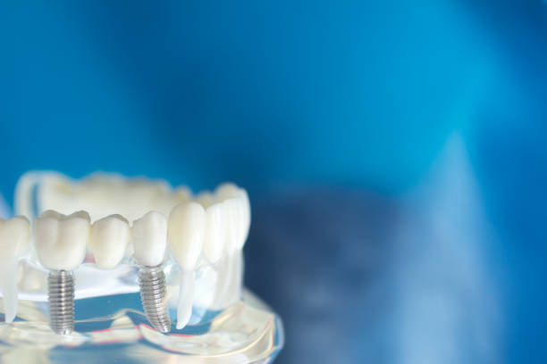 istock Dental teeth mouth dentists teaching model with teeth, gums, molars and wisdom tooth. 851107834