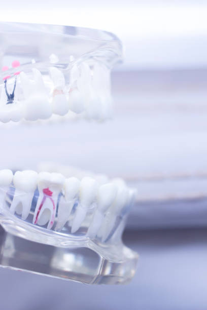 istock Dental teeth mouth dentists teaching model with teeth, gums, molars and wisdom tooth. 851110720