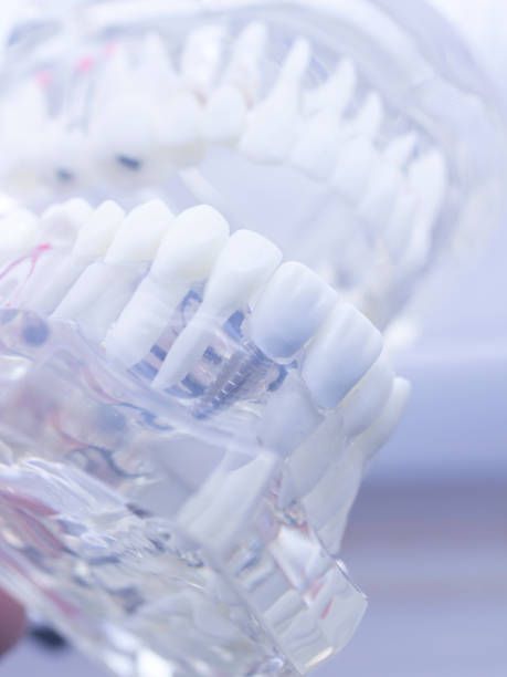 istock Dental teeth mouth dentists teaching model with teeth, gums, molars and wisdom tooth. 851110874