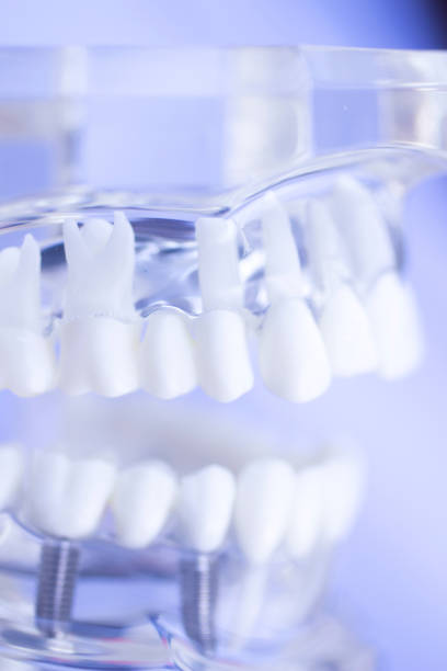 istock Dental teeth mouth dentists teaching model with teeth, gums, molars and wisdom tooth. 851111016