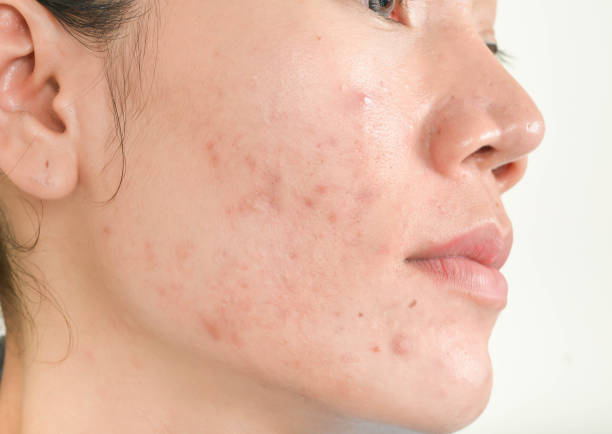 cicatrice da acne sul viso - caratteristica della pelle foto e immagini stock