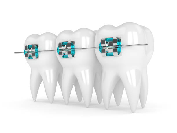 3d render of teeth with braces stock photo