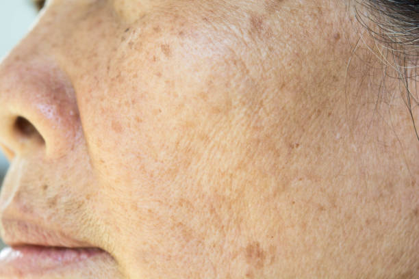 istock freckles on the face. in old women 852008788