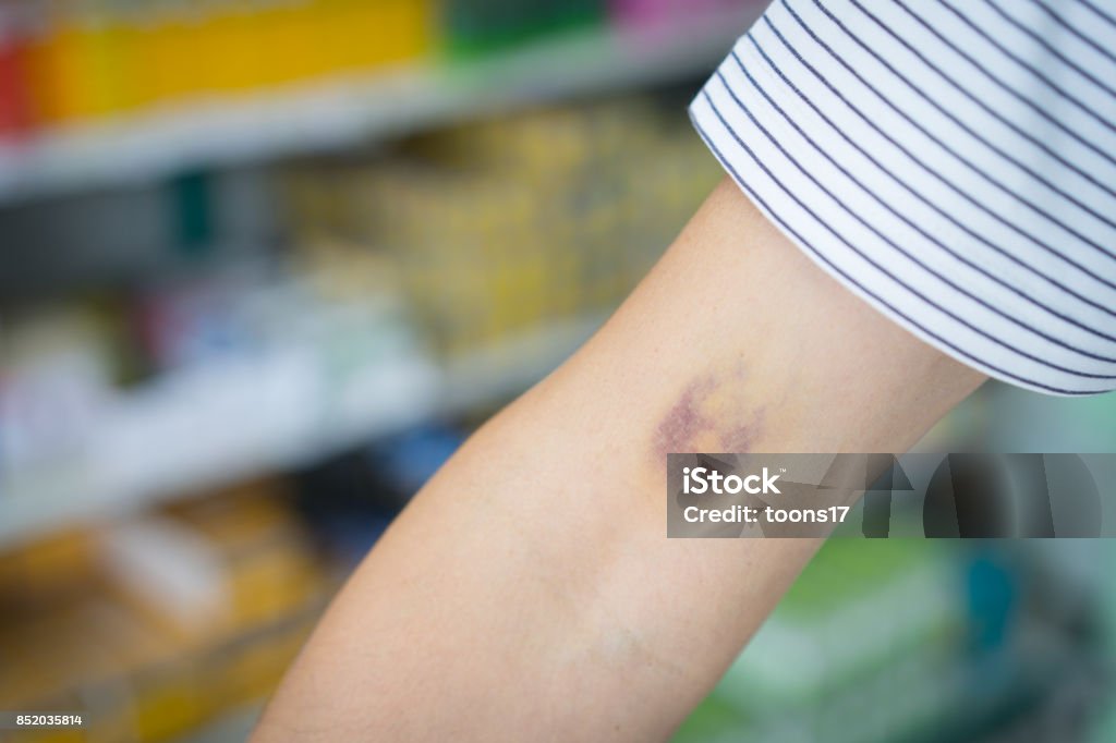 Large hematoma, a bruise on the arm in patient that taken platelet aggregation inhibitor drug on pharmacy background. Bruise Stock Photo