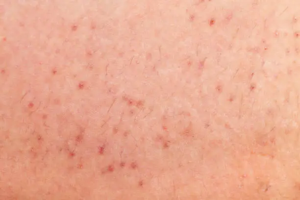 Close up picture of folliculitis on human skin
