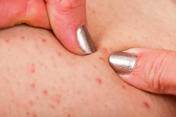 Close up picture of folliculitis on human skin, woman fingers popping it out