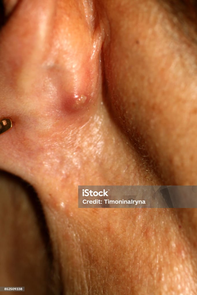 귀 뒤에 농 양입니다 붉은 여드름 염증이 귀 부분에 대한 스톡 사진 및 기타 이미지 - 귀 부분, 뾰루지, 키스 자국 - Istock