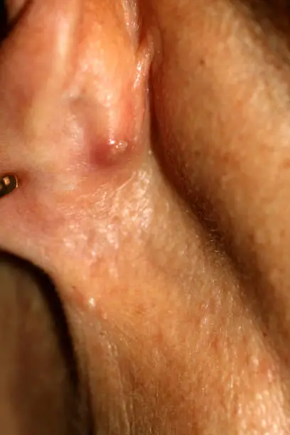 An abscess behind the ear. Inflamed red pimple.