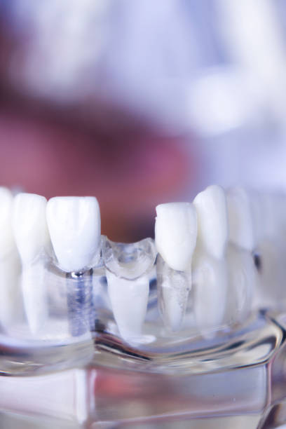 istock Dentsts dental prosthetic teeth, gums, roots teaching student model with gap in front teeth. 852579354