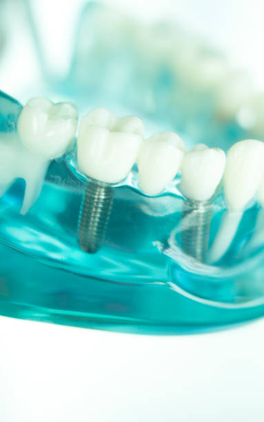 istock Dentsts dental prosthetic teeth, gums, roots teaching student model with titanium metal screw implant. 852579724