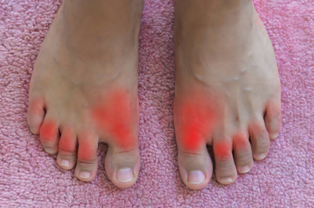 istock Painful and inflamed gout. 853016954