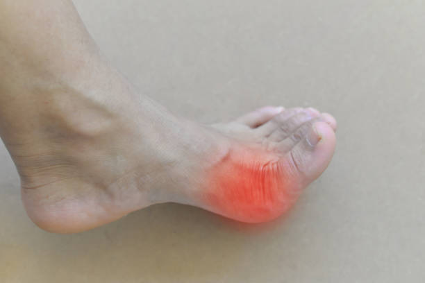 istock Painful and inflamed gout. 853017172