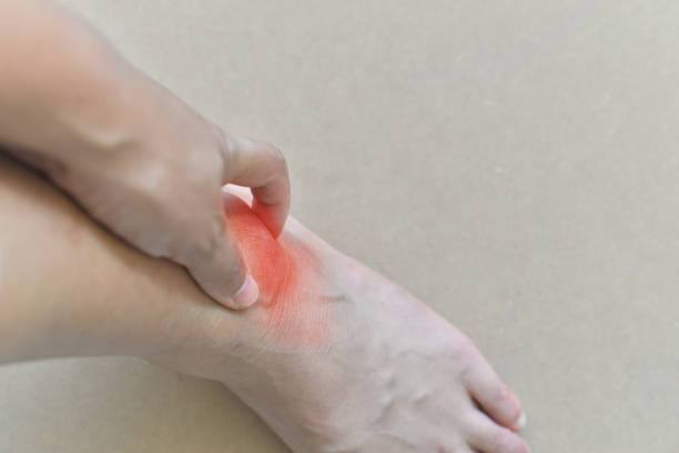 istock Painful and inflamed gout. 853017570