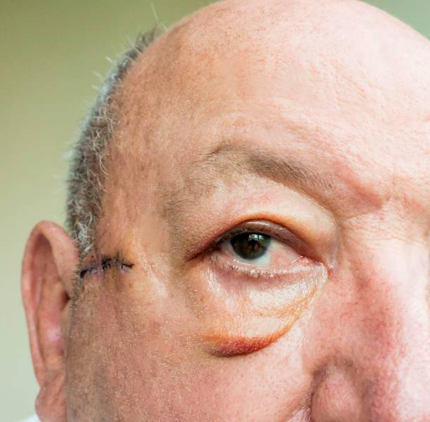 istock Close-up of elderly man face with edema after surgery 853118888
