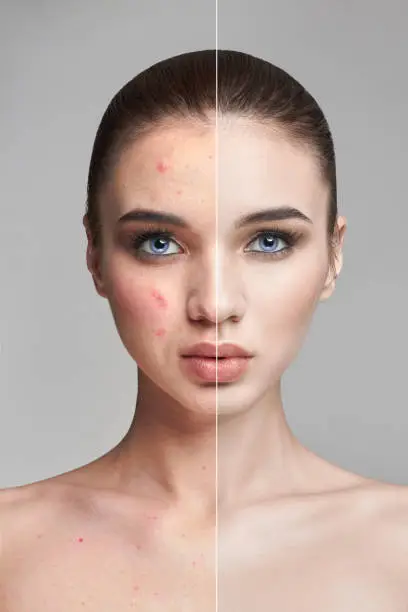 Pimples and acne on the woman's face before and after. Cosmetics to remove pimples and blackheads. Natural natural skin skin. Beautiful woman face closeup, dermatology