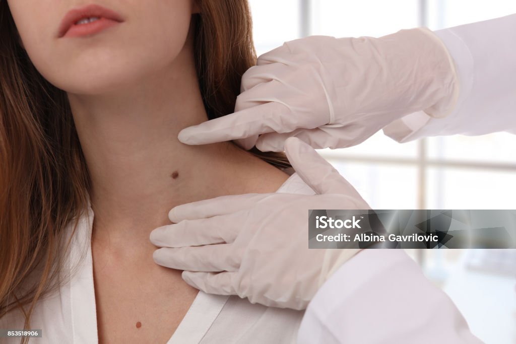 Médecin dermatologue examine la tache de naissance du patient étroite vers le haut. Vérification des taupes bénignes. Enlèvement de tags peau laser - Photo de Grain de beauté libre de droits