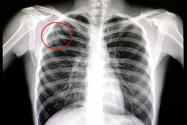 istock a tuberculosis chest film 853721014
