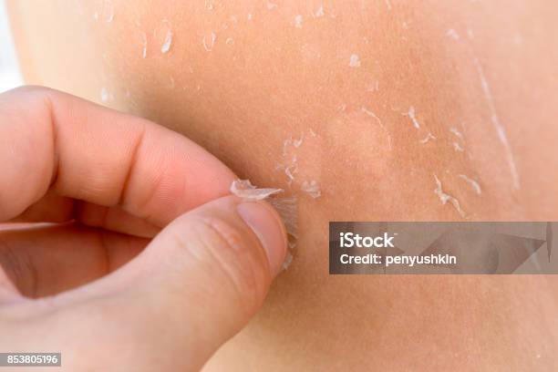 Man Hand Removes Flaky Skin From The Female Back Stock Photo - Download Image Now - Human Skin, Dry, Skin