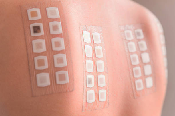 istock Allergy patch test on the back of a young woman 854074272