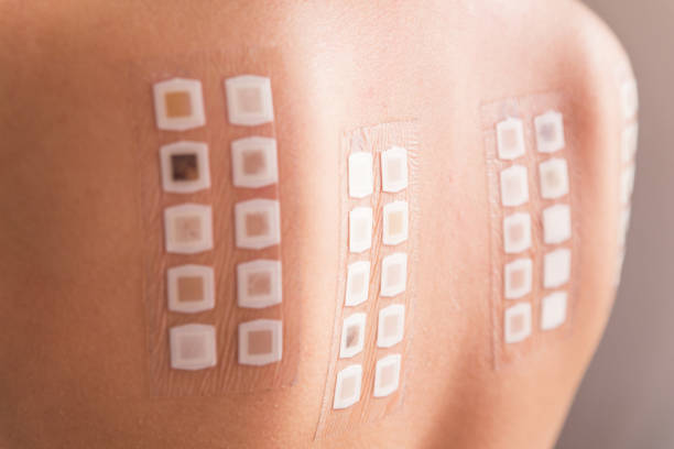 istock Patch test on back of female patient 854074590