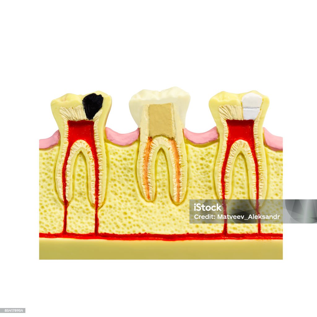 Human tooth gum cross section Tooth Root canal Tooth Detailed anatomy tooth color image stomatology flat style tooth concept design Dental illustration tooth picture dental cavitation treatment layout Abscess Stock Photo