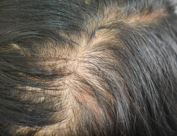 istock thin hair in women 854247442