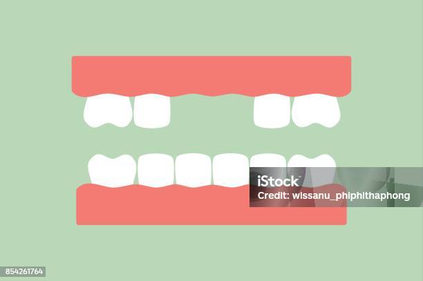 Missing Tooth Denture Model Stock Illustration - Download Image Now - Gap  Toothed, Teeth, Cartoon - iStock