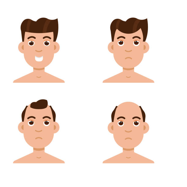 kuvapankkikuvitukset aiheesta hiustenlähtö. kaljuuntumisen tyypit miesten päävektorilla. - receding hairline