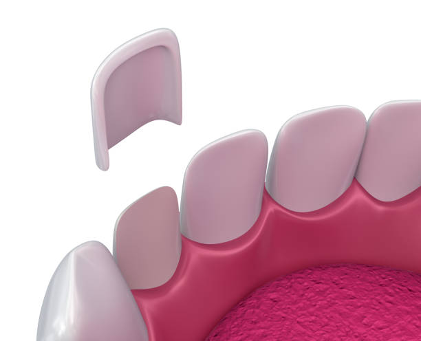 istock Dental Veneers: Porcelain Veneer installation Procedure. 3D illustration 854378184