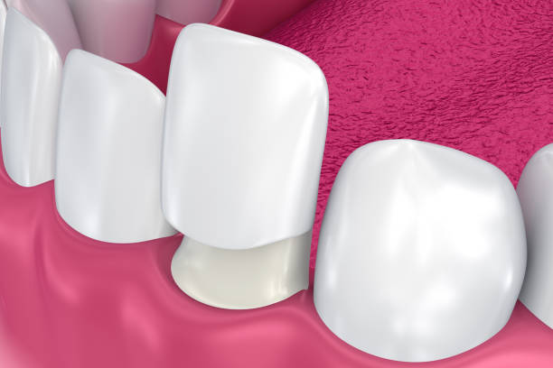 istock Dental Veneers: Porcelain Veneer installation Procedure. 3D illustration 854378218