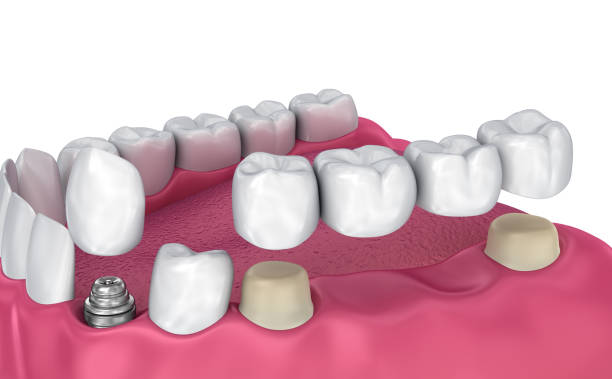 istock Tooth supported fixed bridge, implant and crown. Medically accurate 3D illustration 854378238
