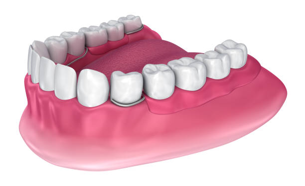 Removable partial denture. Medically accurate 3D illustration Removable partial denture. Medically accurate 3D illustration boreray and stac lee stock pictures, royalty-free photos & images