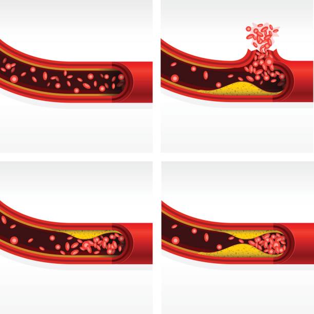 секция артерий с холестерином и тромбозом, церебральным инсультом и инфарктом - human artery illustrations stock illustrations