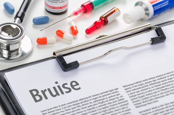 istock The diagnosis Bruise written on a clipboard 854429196
