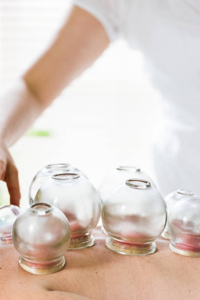 istock Woman lying face down having cupping acupuncture 855128464