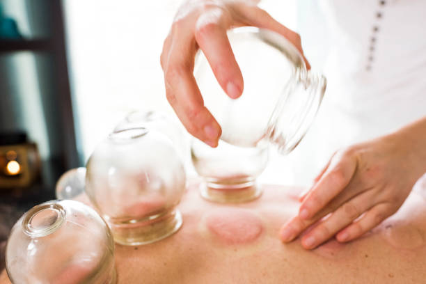 istock Woman removing acupuncture cups from woman's back 855134738