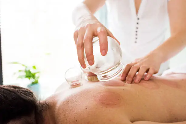 Photo of woman removing acupuncture cups from woman's back. Alternative Medicine