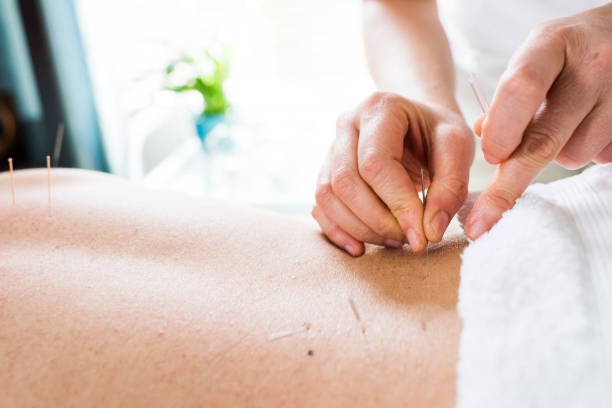 istock Woman having acupuncture treatment 855138010