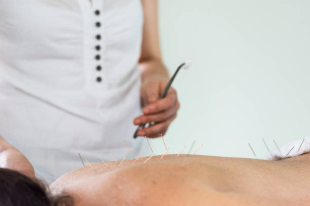 istock Woman having acupuncture treatment 855138752